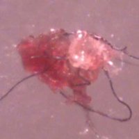 피부괴질 모겔론스 모겔론스병 괴피부질환 Morgellons Disease