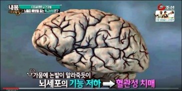 뇌 건강 특급비법 절운동 뇌졸중, 혈관성 치매 해결