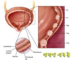 병기에 따른 방광암 생존률 >방광암<