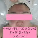 마곡피부관리실 케이엠에스테틱 마곡점 | 작은얼굴만들기 신부 윤곽관리 후기