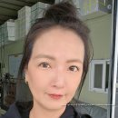 강남병원 | 진주 성형외과 강남JC 쌍커풀수술 후 3년차 절개 새미아웃라인 수술