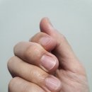 물혹 제거 코숨한의원 후기(9일차)
