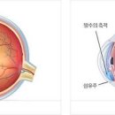 안압이 높으면 효능 및 증상 높아지는 이유 낮추는법 이미지