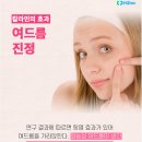 자극받은 여름 피부, 칼라민 성분에 주목! 이미지