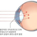연세드림안과의원 | 성인 드림렌즈 부작용 걱정된다면 우선 보세요 - 강동역안과