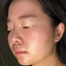 엠디개발 | 베리큐어(BARRICURE) 랩핑 솔루션 엠디 후기｜여드름압출후관리 필수템 사용 리뷰
