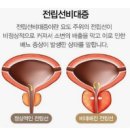 전립선 비대증과 전립선암 이미지