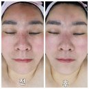 거제에스테틱 뷰티앤힐링 물광관리 받고 탱탱해진 후기