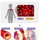 제2의 콜레스테롤이라 불리는 동맥경화의 주범 - 호모시스테인 이미지