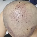 마린당구장 | 놈팬이, 모발이식하다 2편 (수술 다음날 ~ 5일차) - 약혐주의..