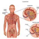 임파선암 증상 이미지