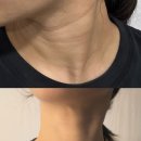 인서어린이집 | 목주름 없애는법, 드라마틱하게 옅어진 목주름 필러 가격 내돈내산 리얼후기❤️