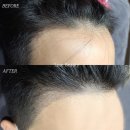 영수헤어라인 | 나는솔로 30기 영수 두피 헤어라인 문신 가격 비용 정보 확인하기