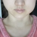 [대전서울브라운치과]매복사랑니발치 리얼 후기(피안멈춤,붓기)