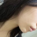 이중턱 튠라이너, 코어스컬프 시술 효과 후기 | 강남피부과