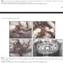 K Implant(케이 임플란트) | 대구수성구임플란트, 시술 후 잇몸 괴사가 일어날 수 있는 이유? <실제 논문 첨부>