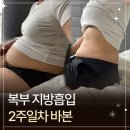 멍이가 웃통벗는날 | 복부지방흡입효과 2주차 전후 바이오본드 바본 얼마나 불편할까?