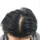 뉴헤어모발성형외과의원 | 서울 강남구 역삼동 탈모관리 뉴헤어모발성형외과의원 위치 가격 후기