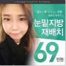 장성형외과의원 | 눈밑지방재배치 후기 찾아봐