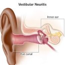 전정신경염 증세, 원인 및 (귀어지럼증, 전정기관염, 어지러움 구토) 이미지