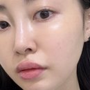 메타플렉스 | 30대 피부 관리 청담피부과 MCT 메타셀ㅣ줄기세포주사 효과 통증 가격 내돈내산 후기