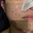 광교 여드름 관리 추천 :: 꼼에스테틱 수원점 80분 여드름 케어 리얼 후기