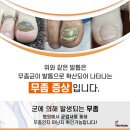 나도손톱 레푸스 개봉점 네이버블로그
