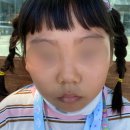 초등학생 얼굴 상처 흉터 없이 치료한 후기 | 학교안전공제회 보험 청구방법
