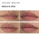 의정부 멜라닌케어 입술 석까네 살롱에서 칙칙한 입술 색소 관리로 화사하게