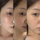 압구정 루나의원 루비레이저 내돈내산 후기 ｜당일 ~7일차 (1주일차) 관리방법｜주근깨 기미 제거 시술