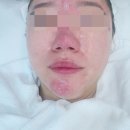 율하로 | [김해율하피부관리] 더밝음메디에스테틱 여드름+물방울 관리 후기