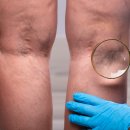 푸른맥흉부외과의원 | 하지정맥류 초기증상 이 중 3개 이상 해당된다면 확인