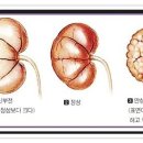 만성신부전증(콩팥병) 이미지