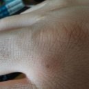 미소가인피부과의원 | 손사마귀 원인과 냉동치료(액화질소)미소가인피부과후기