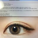 직접 발로뛴 성형외과 상담 후기3 - 김한성 성형외과