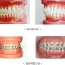 [치아교정] 치아교정의 수많은 종류를 알아봅시다. 이미지