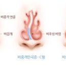 만곡 이미지