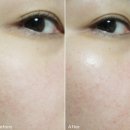 도곡역 피부과 레비나스 리프팅 + 큐어젯 스킨보톡스 일주일후기!