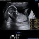 방배로 163 (1) | 2차 기형아 신경관결손 검사 임신 15주차 초음파 정기검진 아기 몸무게