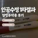 [직장인 임신준비] 인공수정 1차 수정 후기 및 사이클로제스트 질정 부작용 당첨