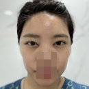 신논현역 눈밑지 아이리쥬란 이마지방이식 내돈내산 리얼리티 후기