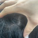 미작헤어블러그 | 의정부 두피문신 제거 후기｜SMP 제거 1회 받아본 솔직한 내돈내산 후기