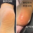 뷰티피아메디컬 | 루원시티 발각질 케어, 뷰티피아 가정점에서 아기발로 변신