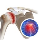 오십견의 원인과 비수술적 치료 이미지