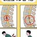 허리디스크 증상 척추관 협착증 차이 원인 치료방법 이미지