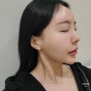 광주양지병원 | 광주 상무지구 피부과 텐써마 300샷 고현정 리프팅 후기