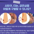 발바닥 굳은살 티눈 원인 뭘까? 가려움 통증 각질 제거 방법 이미지