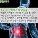 오래 앉아있으면 생기는 문제 앉아있을때 허리통증 이미지