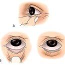 [에이블성형외과] 상안검/하안검 이미지