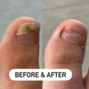 와이제이케어(YJ CARE) | 여름 내내 아프던 문제성발톱, 광명사거리문제성발톱 푸스케어 구로항동점에서 드디어 해결 ✨